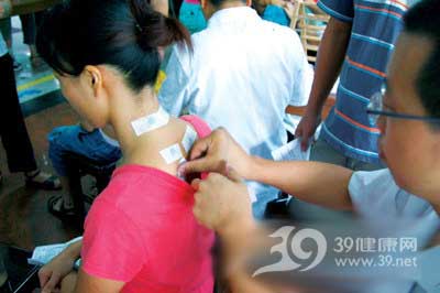 夏季天灸 強身防病不要等